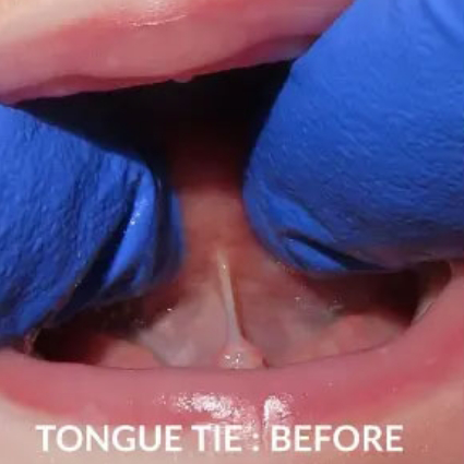 Close up of child's mouth with tongue-tie visible