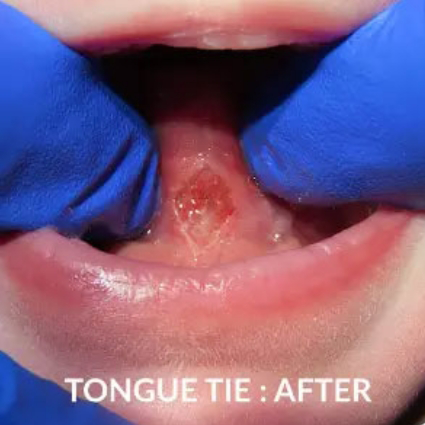 Close up of child's mouth after tongue-tie treatment