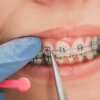 Close up of smiling patient with traditional braces