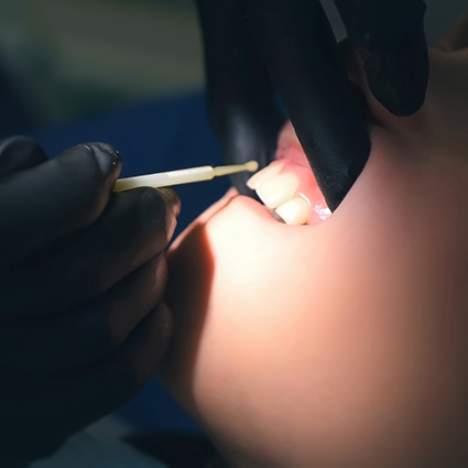 Applying fluoride to patient's teeth