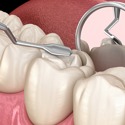 Illustration of tooth being refilled after pulp therapy