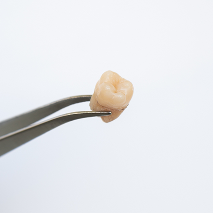 Close up of extracted tooth held by metal instrument